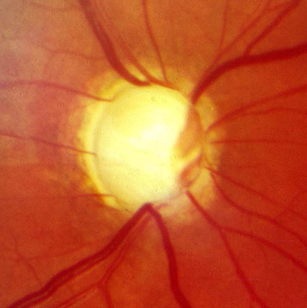 Simulazione della visione con glaucoma
