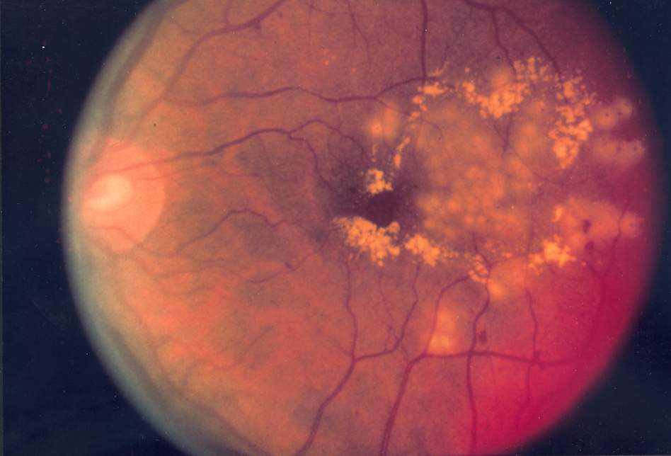 Fotografia del fundus oculare con trattamento laser